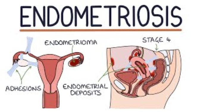 endomeriosis
